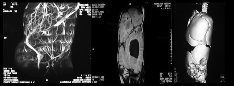 MR venogram, 3D CT, and Sagittal MRI of craniopagus twins